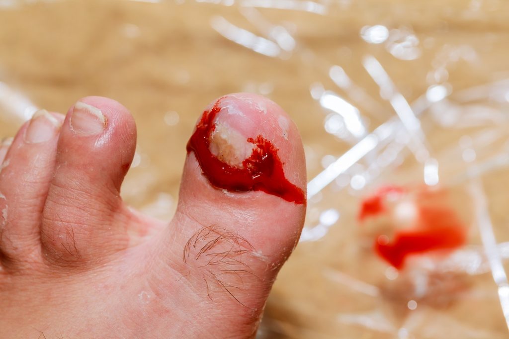 Leg injury torn nail blood Bruise on toe nail on right foot man