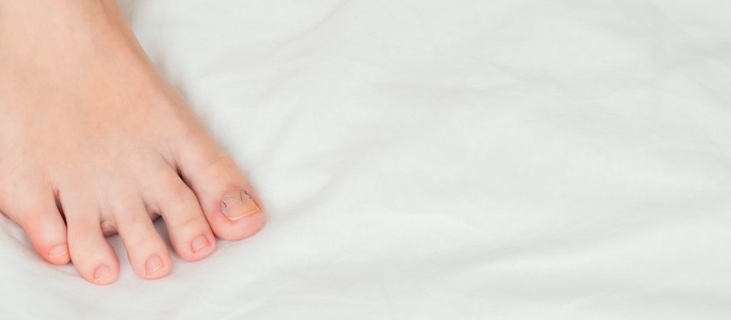 Toenail clamp is mounted on an ingrown toenail