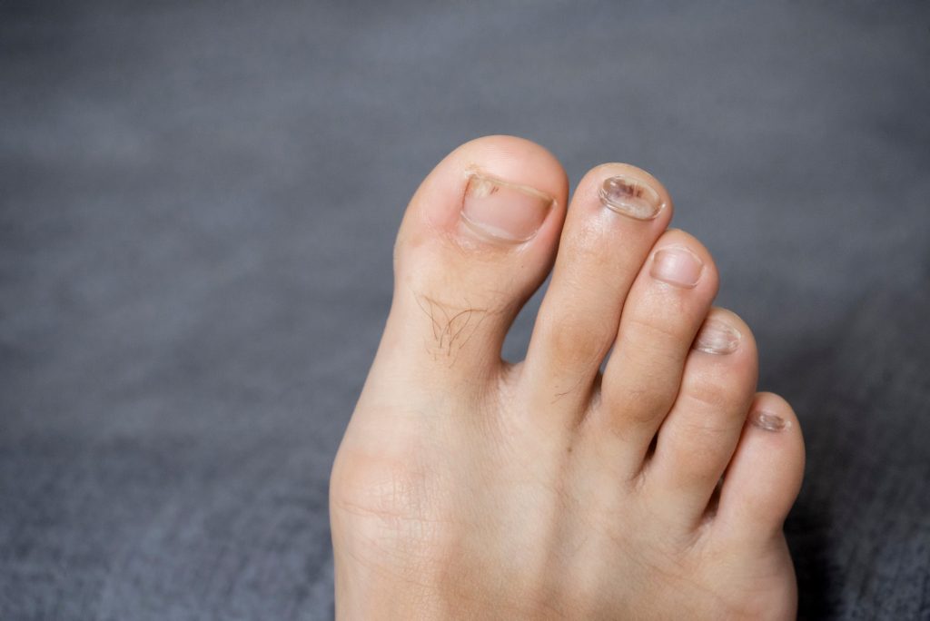 toenail problems fungus. nail disease.